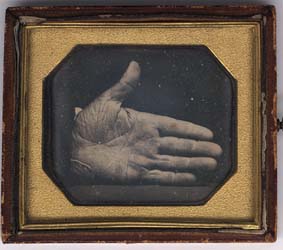 The branded hand of Captain Jonathan Walker Daguerreotype